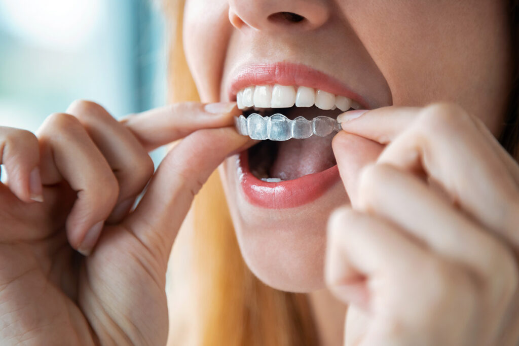 invisalign in Century City